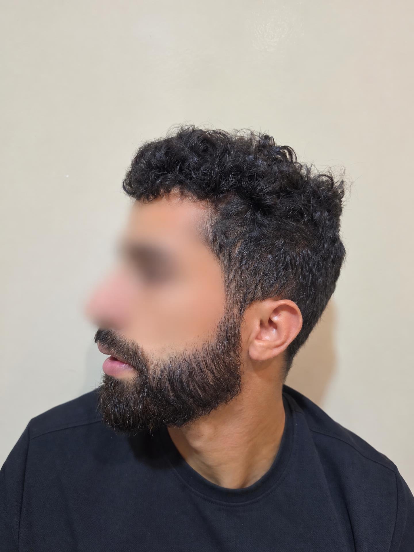 قبل وبعد — زراعة الدقن