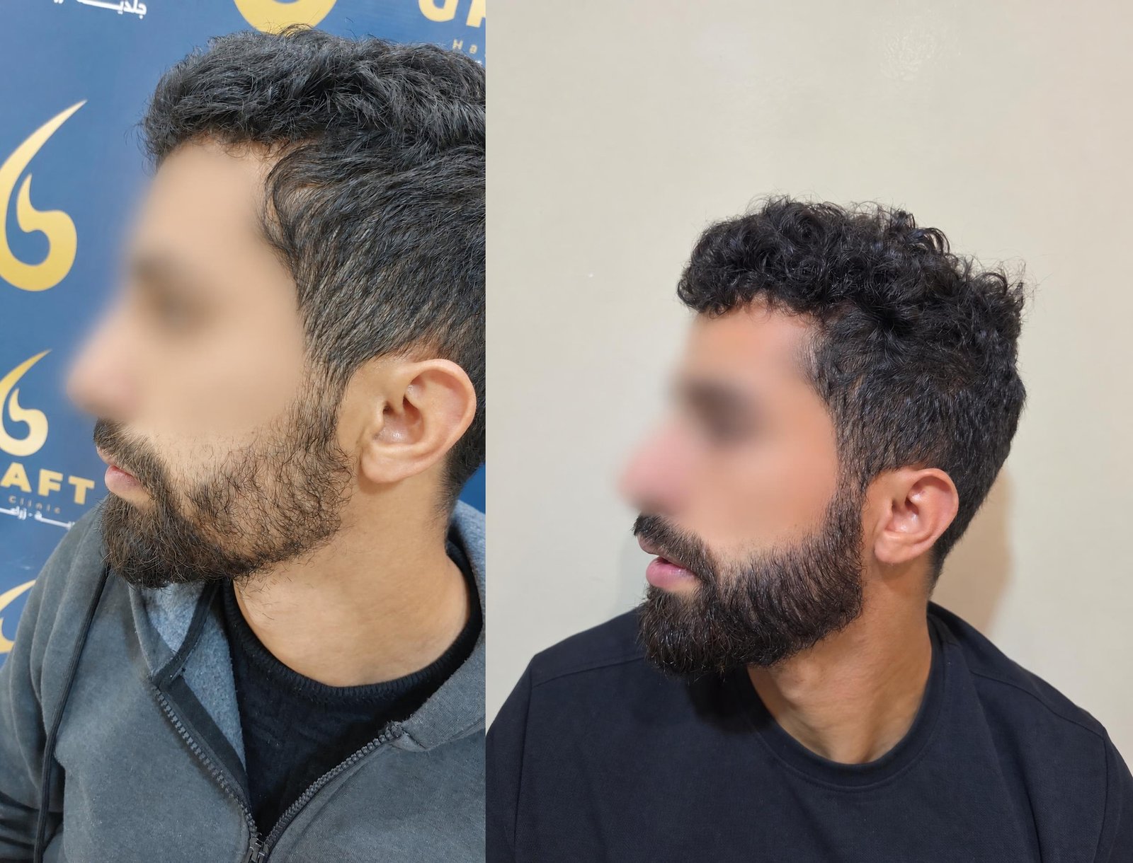 قبل وبعد — زراعة الدقن