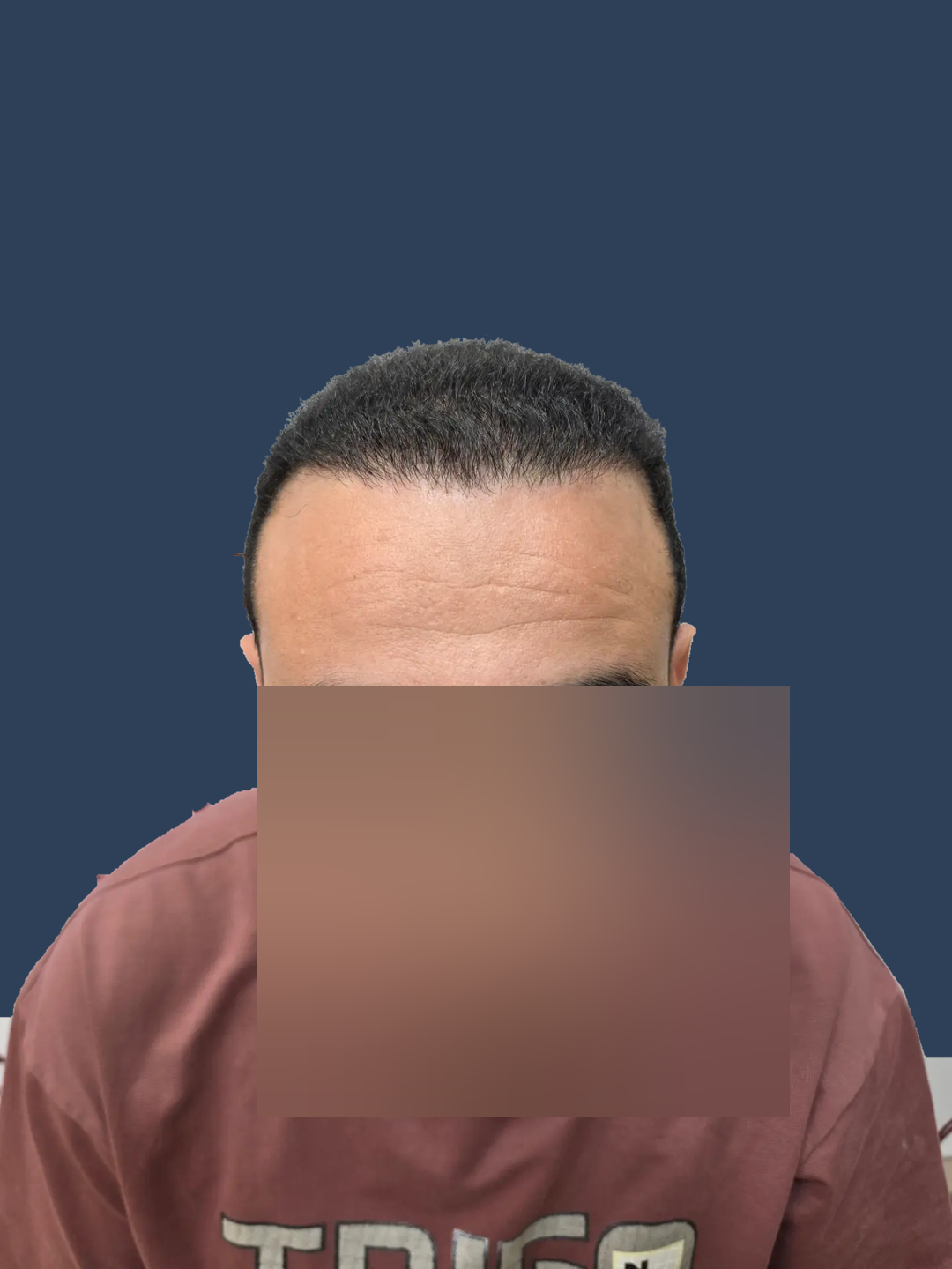 قبل وبعد — خط الشعر الأمامي