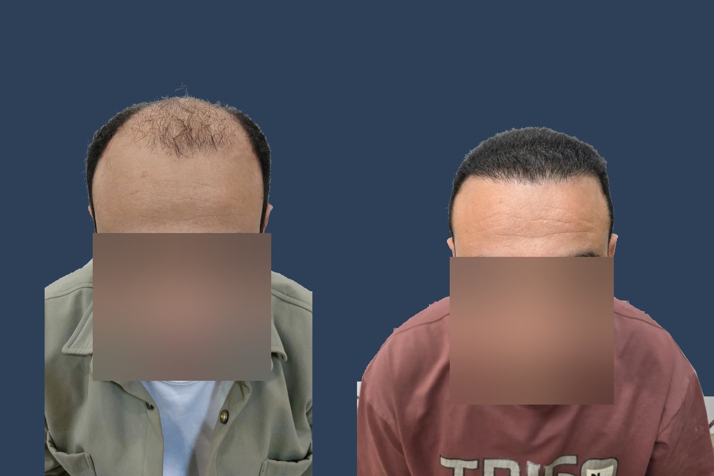 قبل وبعد — خط الشعر الأمامي