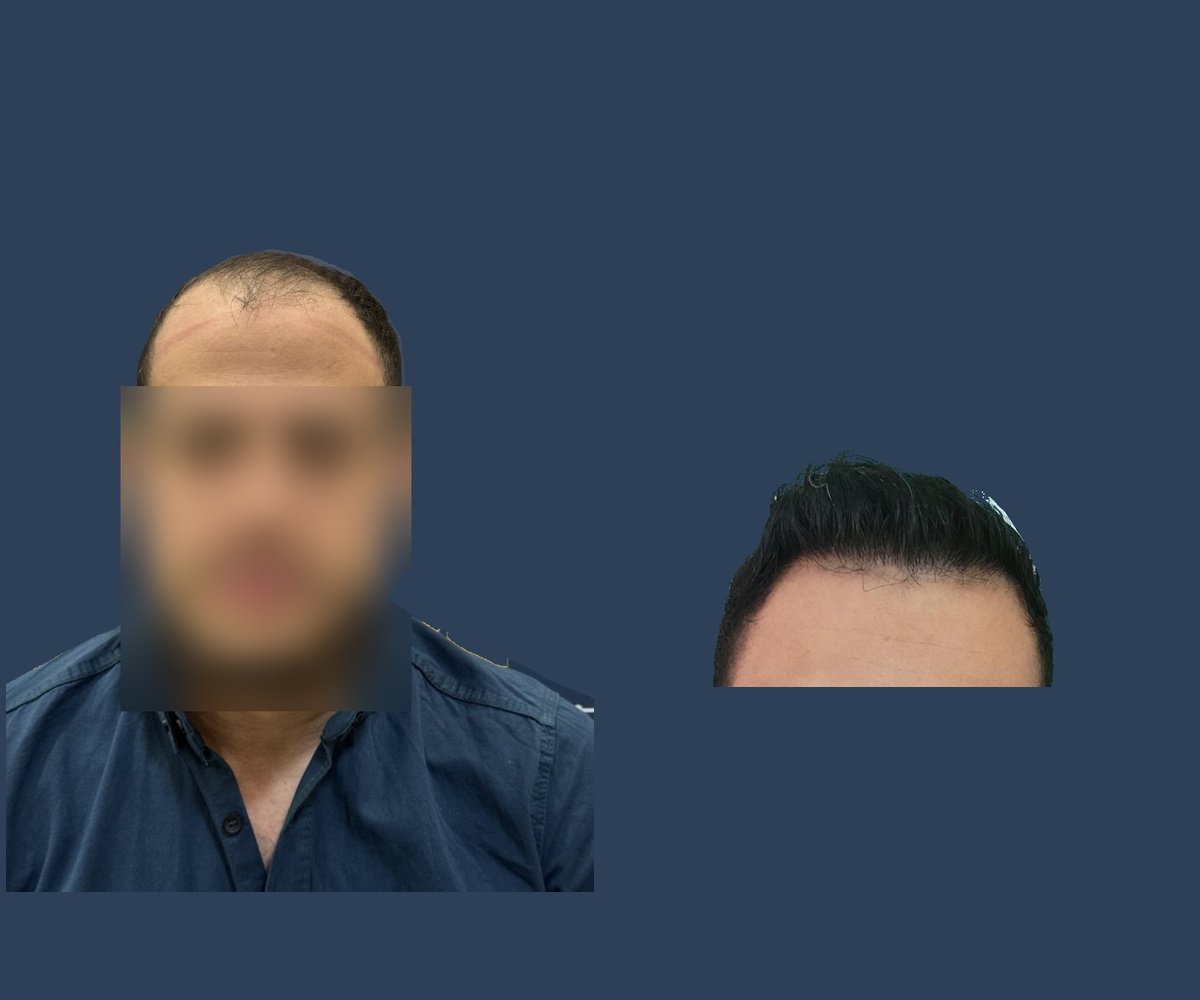 قبل وبعد — استعادة خط الشعر